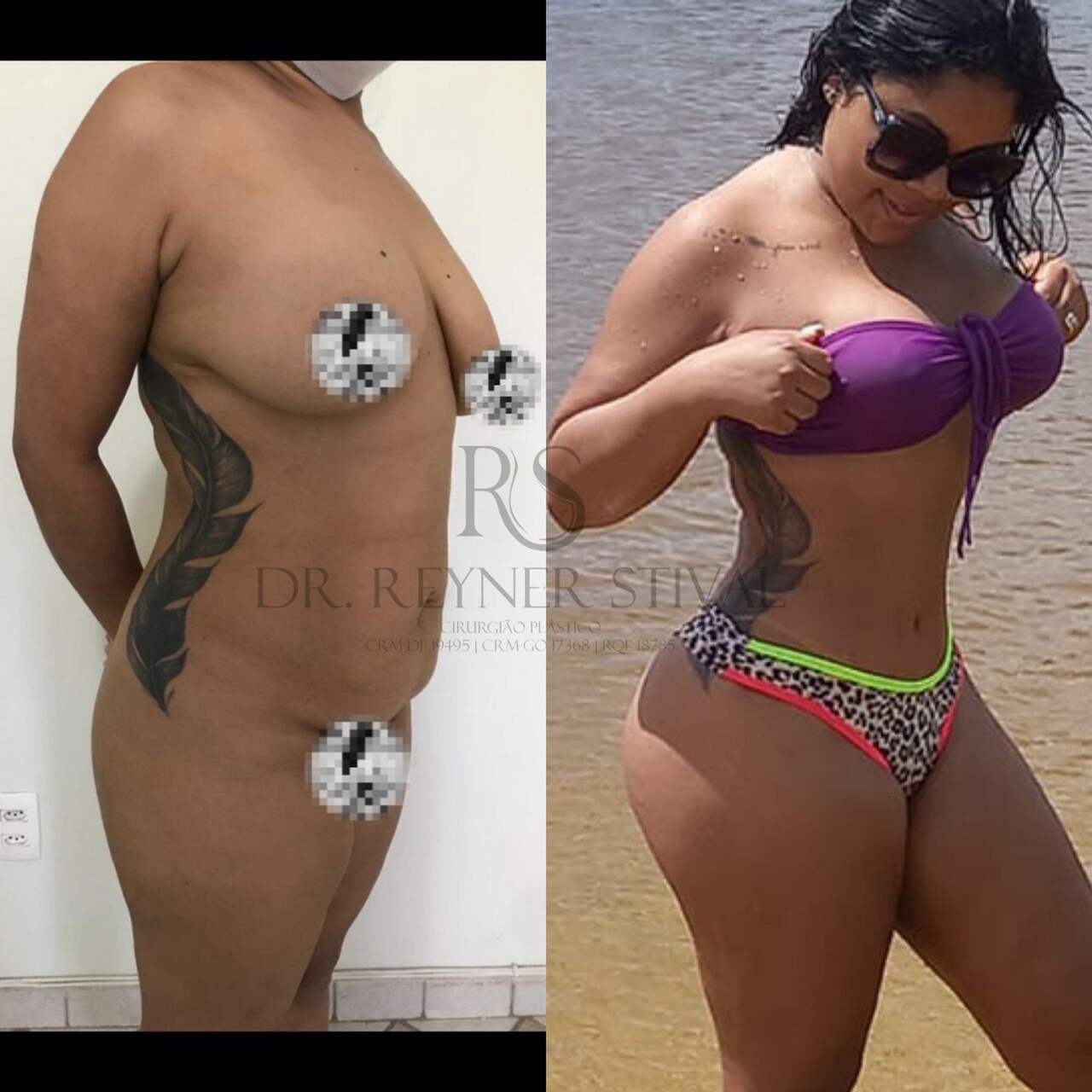 Mastopexia e Abdominoplastia: Vantagens e desvantagens ao combinar os dois procedimentos?