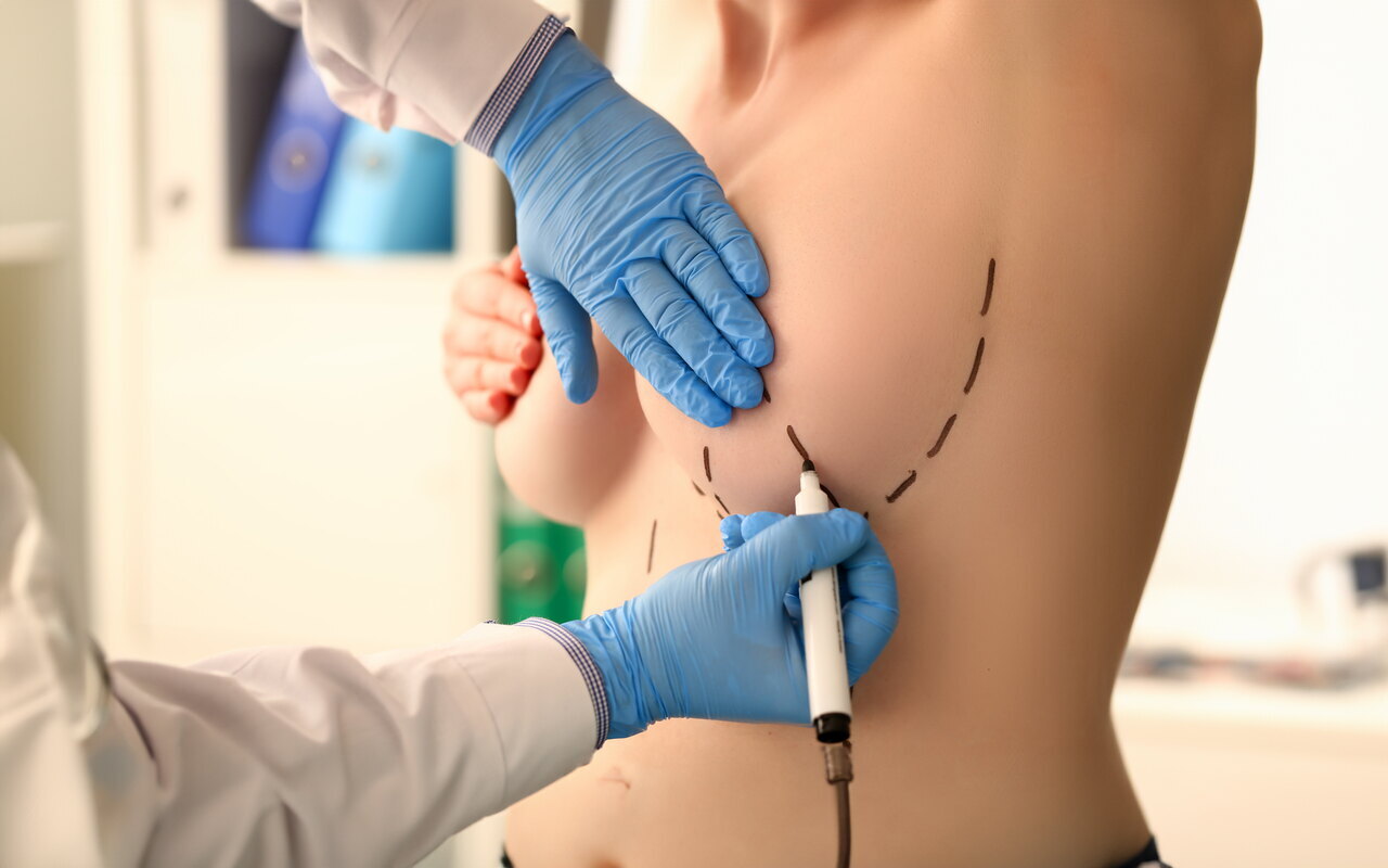 Quais os tipos de incisões realizadas para a mamoplastia de aumento?