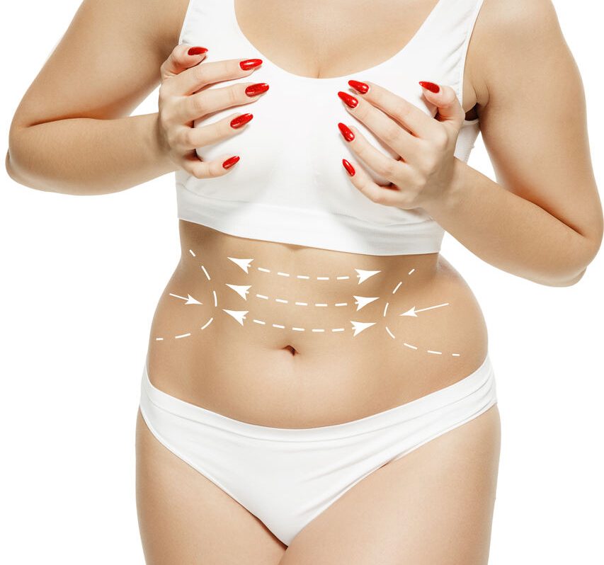 Cirurgião plástico Brasília – Posso fazer abdominoplastia e mamoplastia juntas?