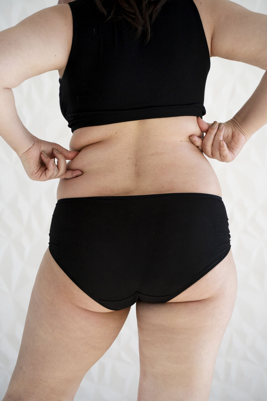 As gordurinhas na lateral da cintura te incomodam? Saiba mais sobre a Flancoplastia!