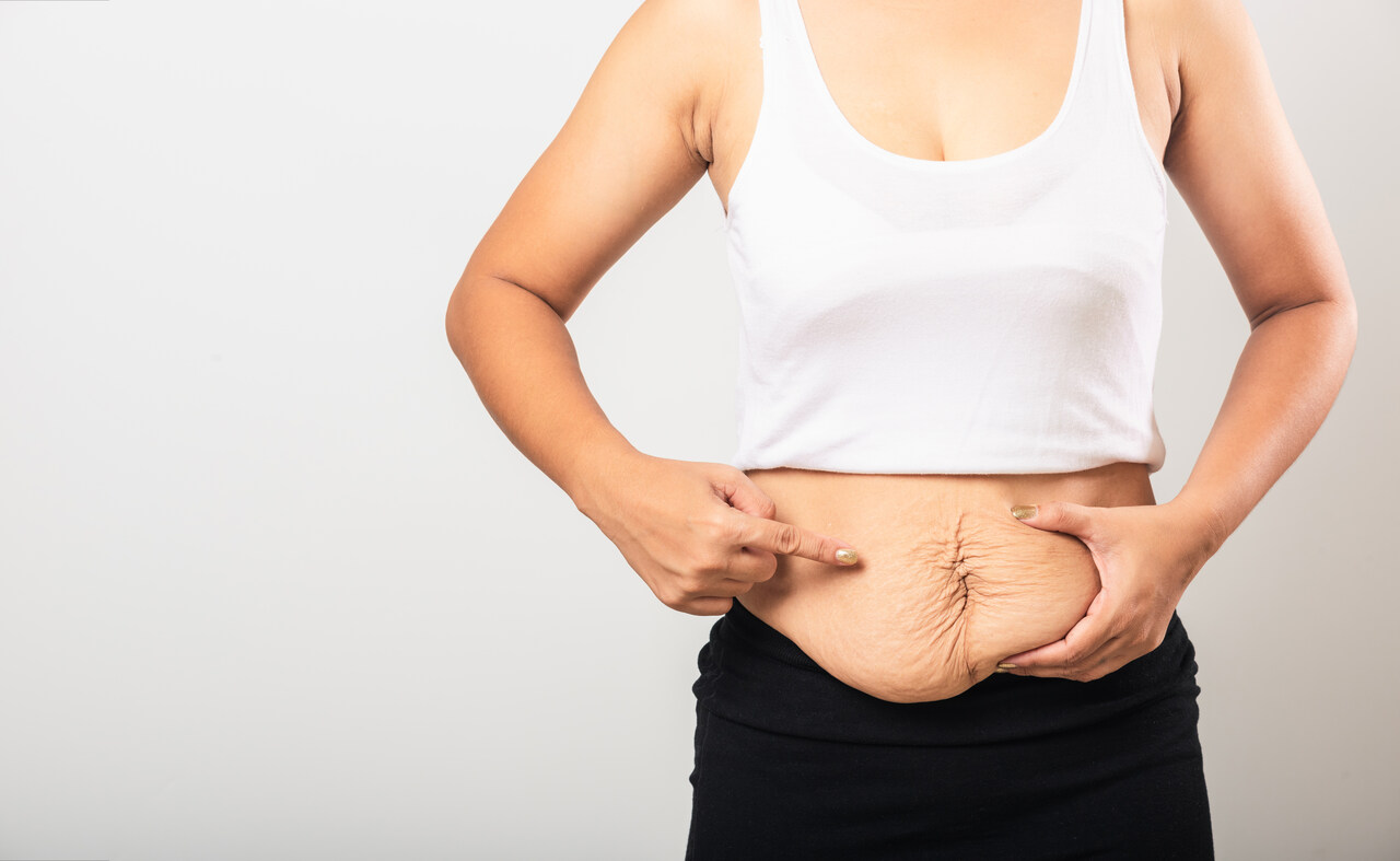 Abdominoplastia em âncora: para quem é indicada?